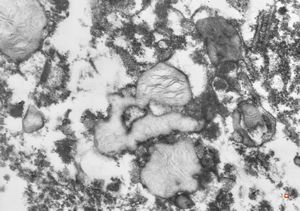 M,27y. | intracellular cholestasis - intoxication